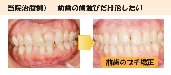 前歯プチ矯正の治療例