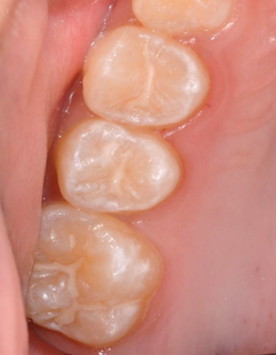 子供の予防歯科と虫歯治療